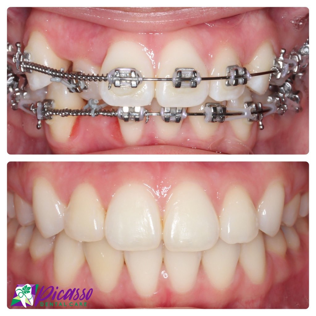 Dramatic Improvement After Early Orthodontic Treatment